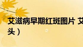 艾滋病早期红斑图片 艾滋病早期红斑图片 舌头）