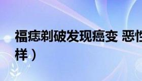 福痣剃破发现癌变 恶性痣的图片癌变后会怎样）