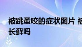 被跳蚤咬的症状图片 被跳蚤咬的症状图片会长藓吗