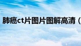 肺癌ct片图片图解高清（肺癌ct片图片图解）