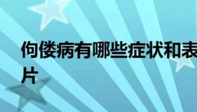 佝偻病有哪些症状和表现 婴儿佝偻病睡姿图片